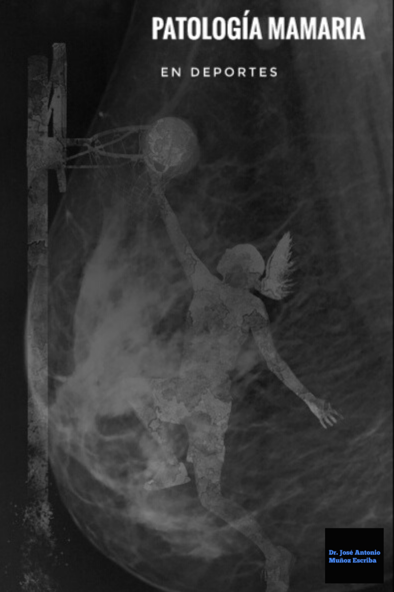 Mamografía de una mama densa donde se observa la imagen de la silueta de una mujer jugando basket intentando encestar una balón de basketball