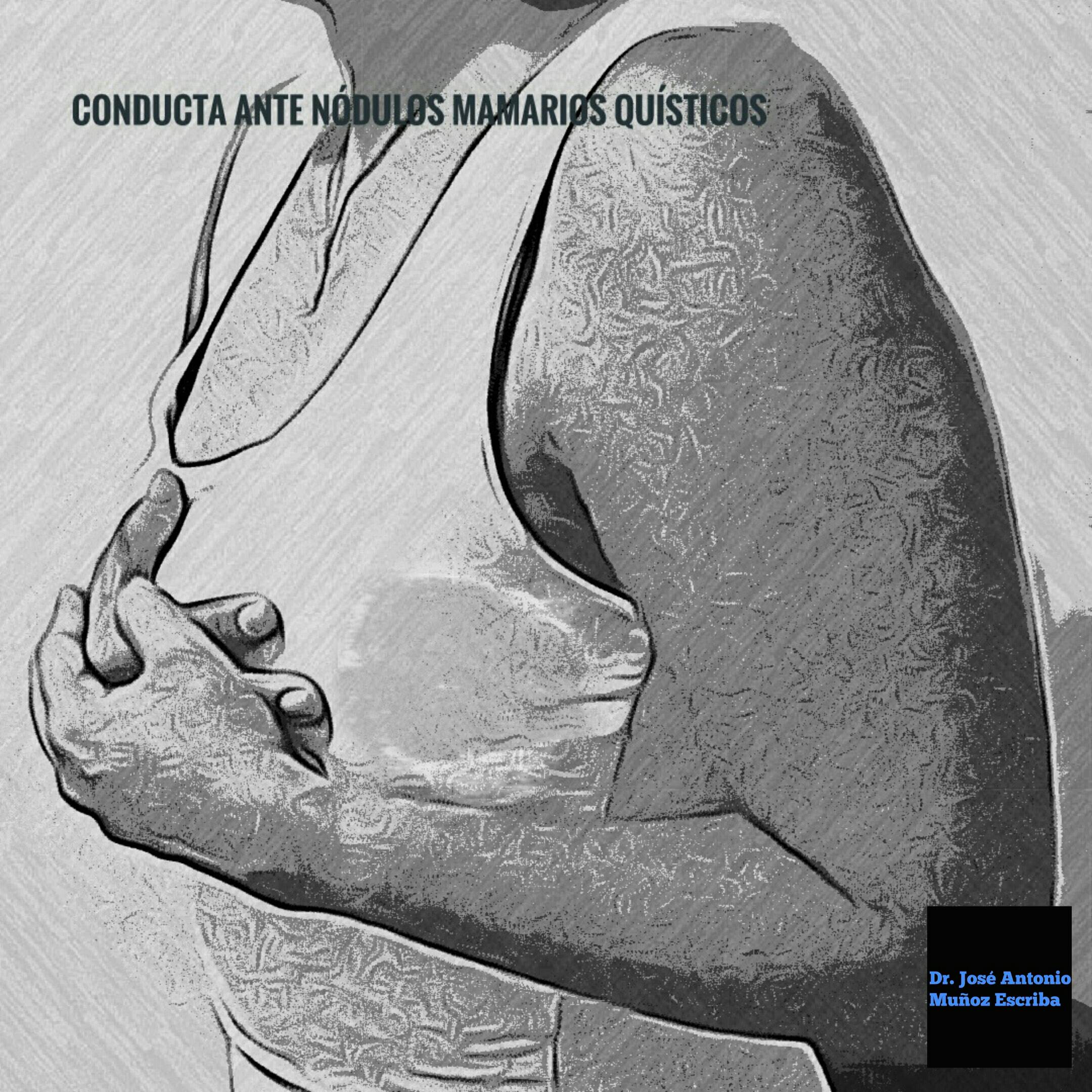 Mujer joven con las manos en uno de sus senos en señal de dolor mamario. Se observa de forma superpuesta la imagen de una lesión quística al ultrasonido