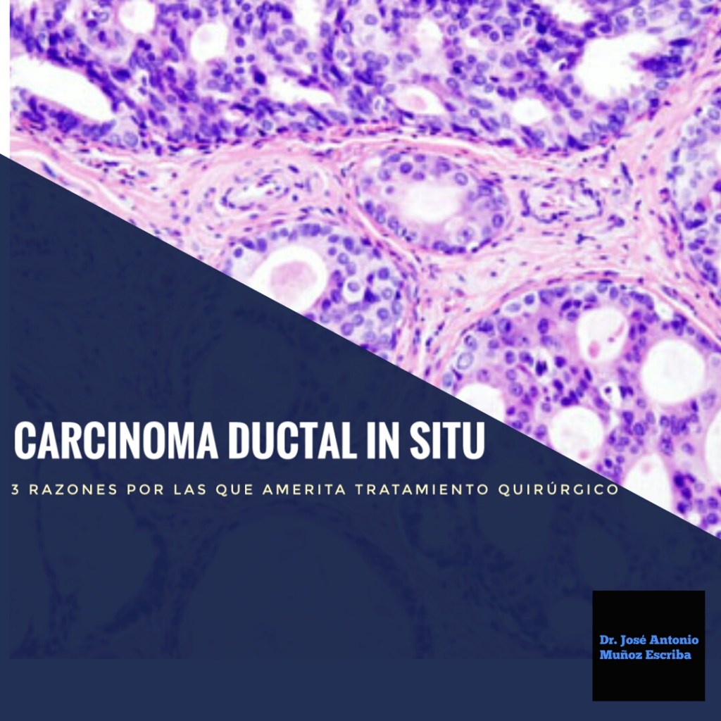 Imagen al microscopio de una lámina de biopsia de un carcinoma ductal in situ