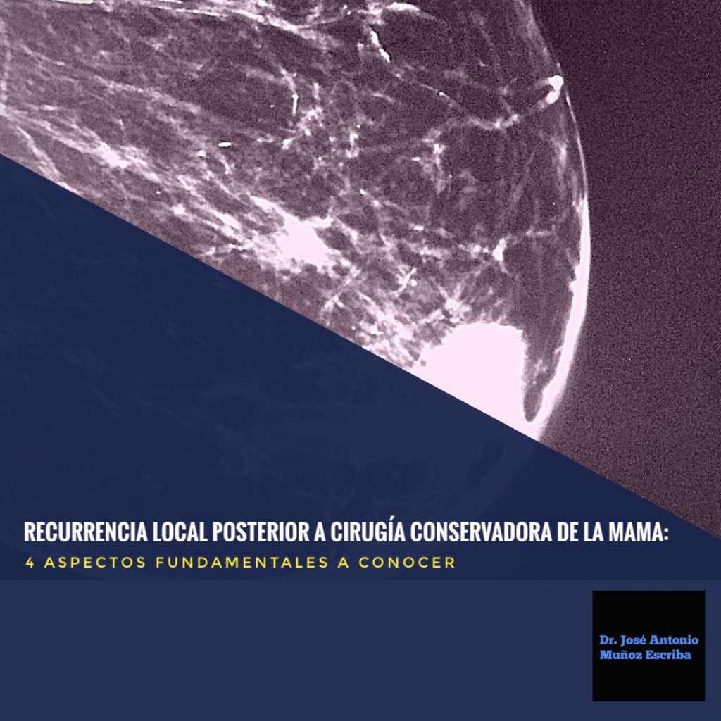Mamografía en la que observa una masa irregular de bordes mal definidos de alta radiodensidad, asociada a microcalcificaciones pleomórficas