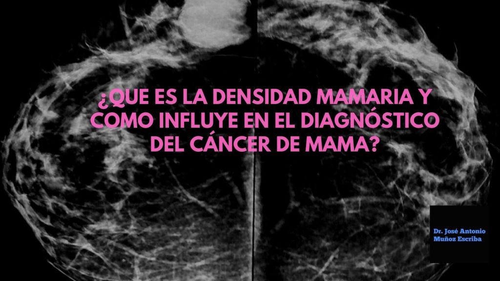 Mamografía en proyección craneo-caudal, en la que se observa en la mama derecha la presencia de una lesión radiodensa, forma redondeada, de bordes poco definidos e irregulares, compatible con un probable cáncer de mama. Las mamas tienen una densidad intermedia ACR B, de acuerdo a la nomenclatura utilizada por el Colegio Americano de Radiólogos