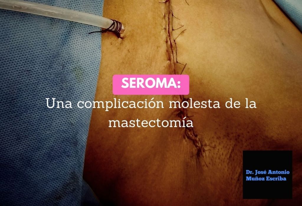 Fotografía tomada por el Dr. José Antonio Muñoz Escriba de una mastectomía radical modificada tipo Madden izquierda en el postoperatorio inmediato en la que se ve la herida operatoria con puntos de sutura y la salida de un drenaje aspirativo cerrado