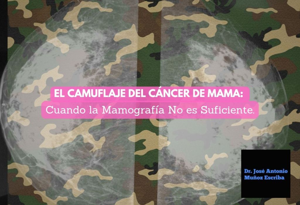 Mamografia en la que observa superpuesta una imagen de camuflaje. Destaca la dificultad de este estudio para el diagnóstico del cáncer lobulillar infiltrante